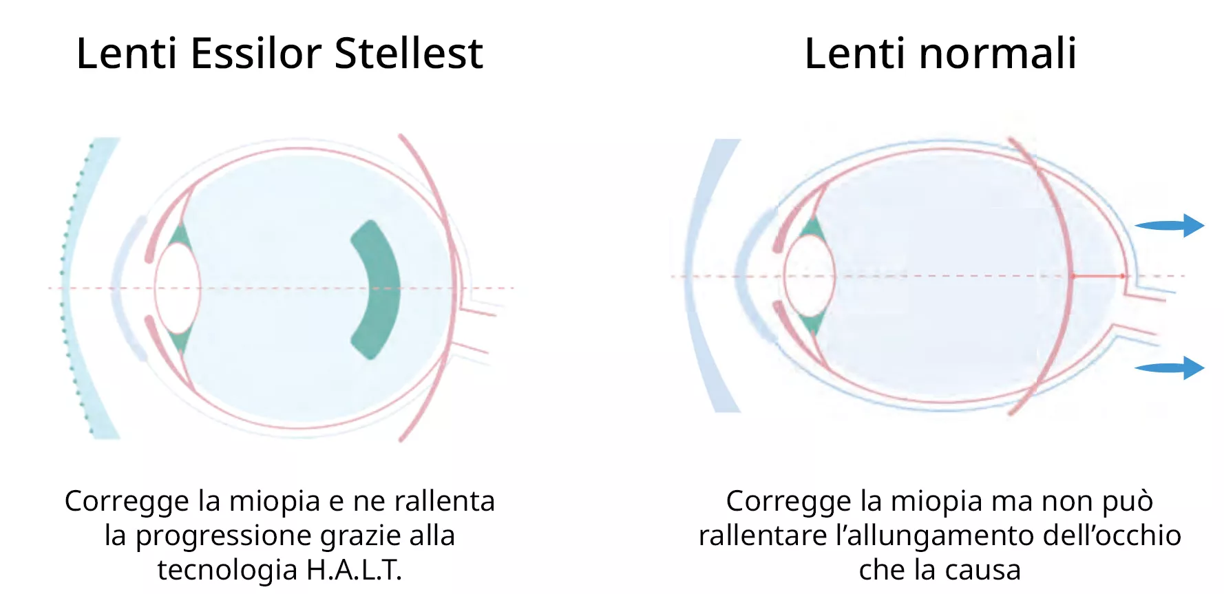 Lenti Essilor Stellest: rallentano la progressione miopica in media del 67%